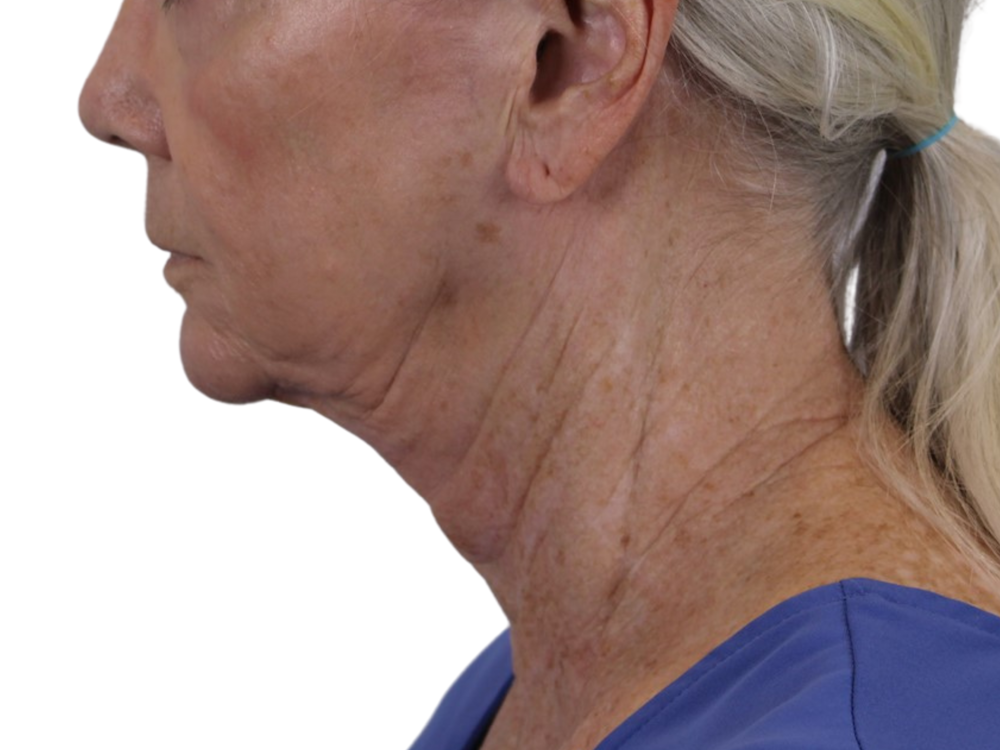 Deep Neck Lift Before & After Gallery - Patient 143555692 - Image 5