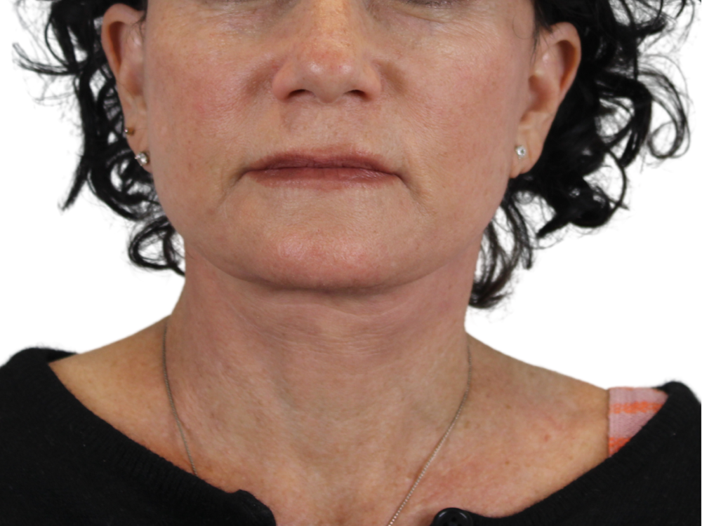 Deep Neck Lift Before & After Gallery - Patient 143555691 - Image 2