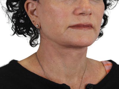 Neck Lift Before & After Gallery - Patient 143555691 - Image 4