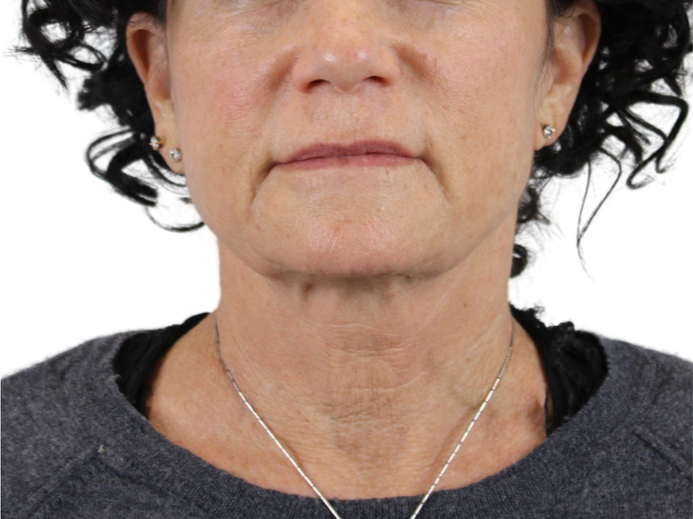 Neck Lift Before & After Gallery - Patient 143555691 - Image 1