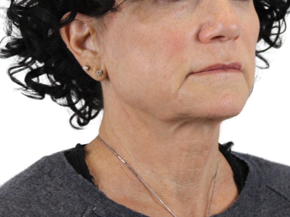 Neck Lift Before & After Gallery - Patient 143555691 - Image 3