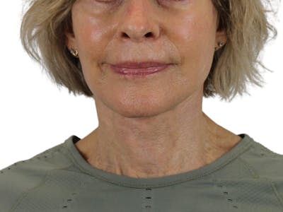 Deep Neck Lift Before & After Gallery - Patient 143555695 - Image 2