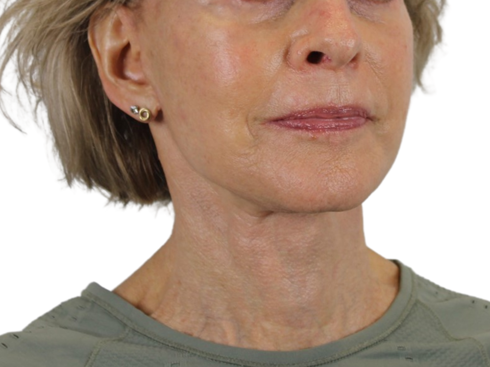 Neck Lift Before & After Gallery - Patient 143555695 - Image 4