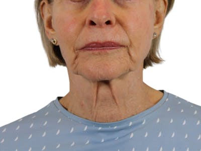 Deep Neck Lift Before & After Gallery - Patient 143555695 - Image 1