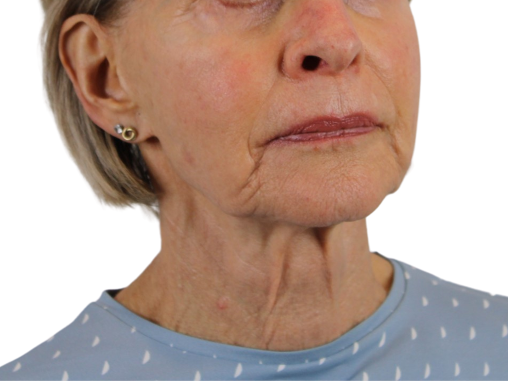 Deep Neck Lift Before & After Gallery - Patient 143555695 - Image 3