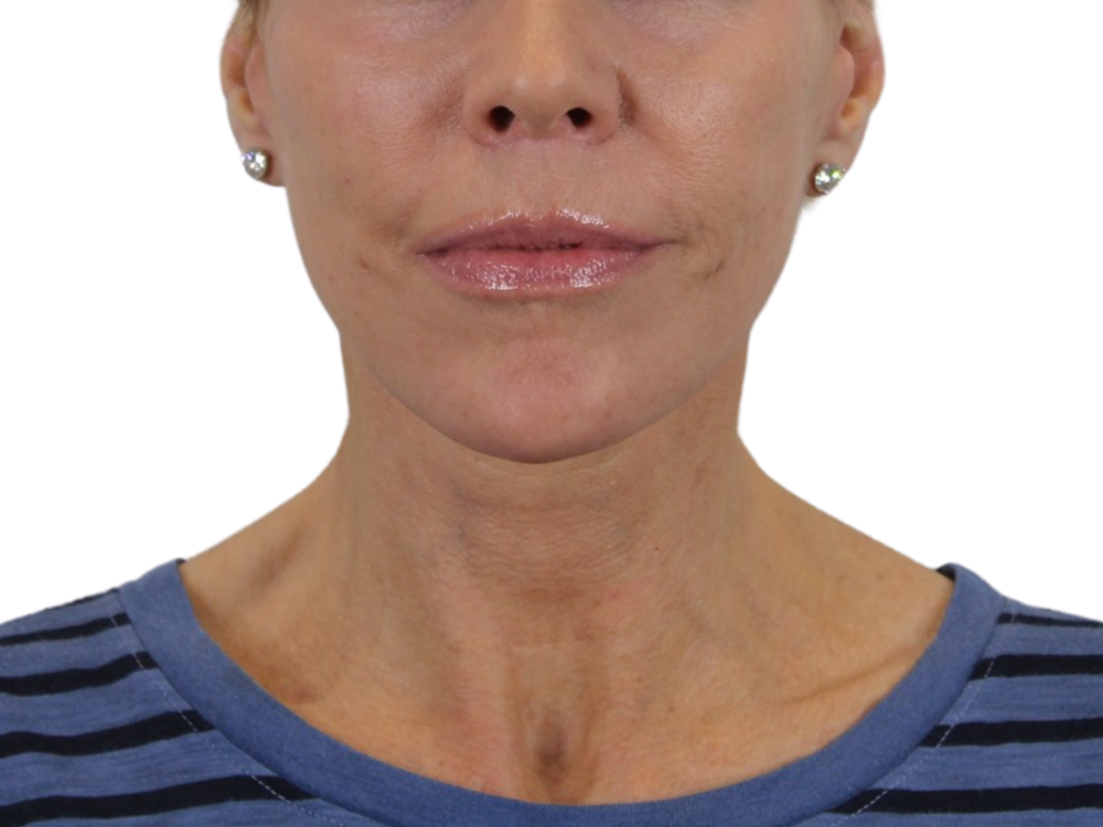 Neck Lift Before & After Gallery - Patient 143555694 - Image 2