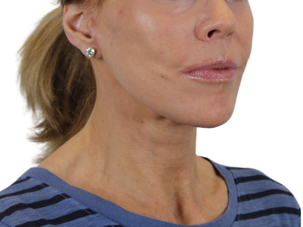 Neck Lift Before & After Gallery - Patient 143555694 - Image 3