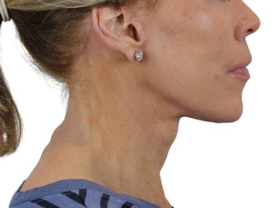 Deep Neck Lift Before & After Gallery - Patient 143555694 - Image 6