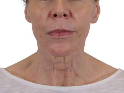 Deep Neck Lift Before & After Gallery - Patient 143555694 - Image 1