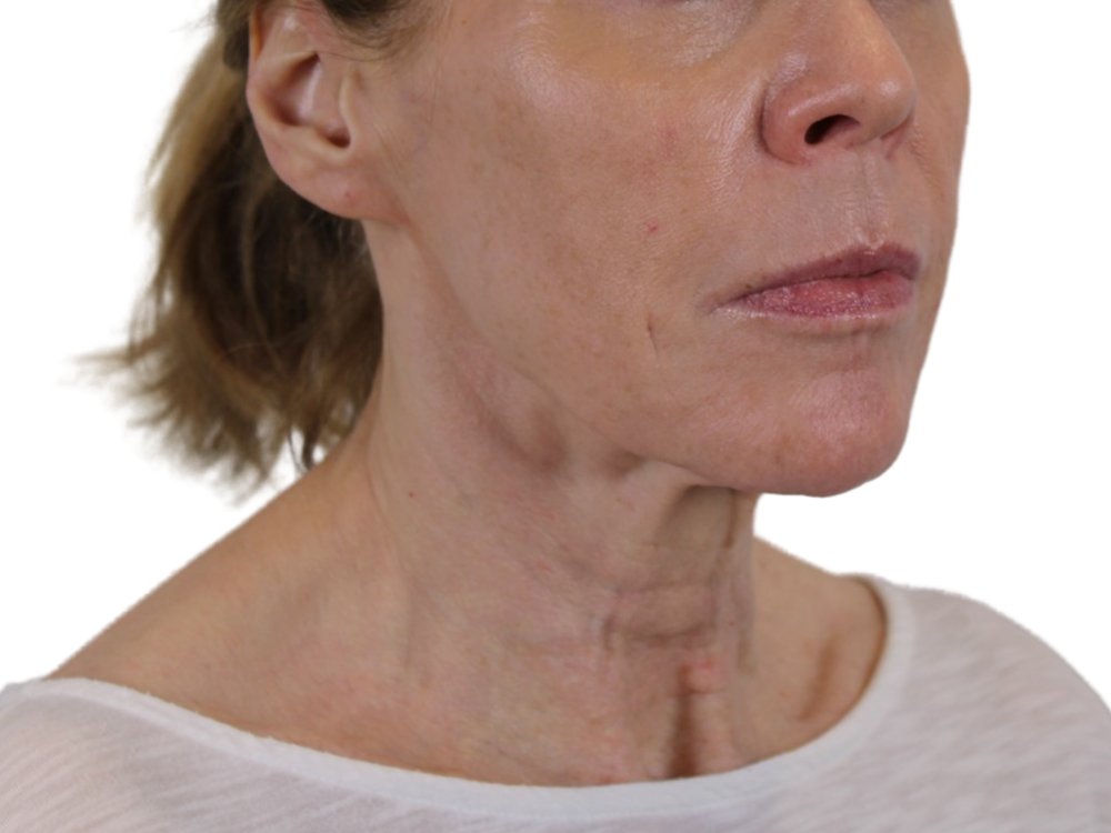 Deep Neck Lift Before & After Gallery - Patient 143555694 - Image 4