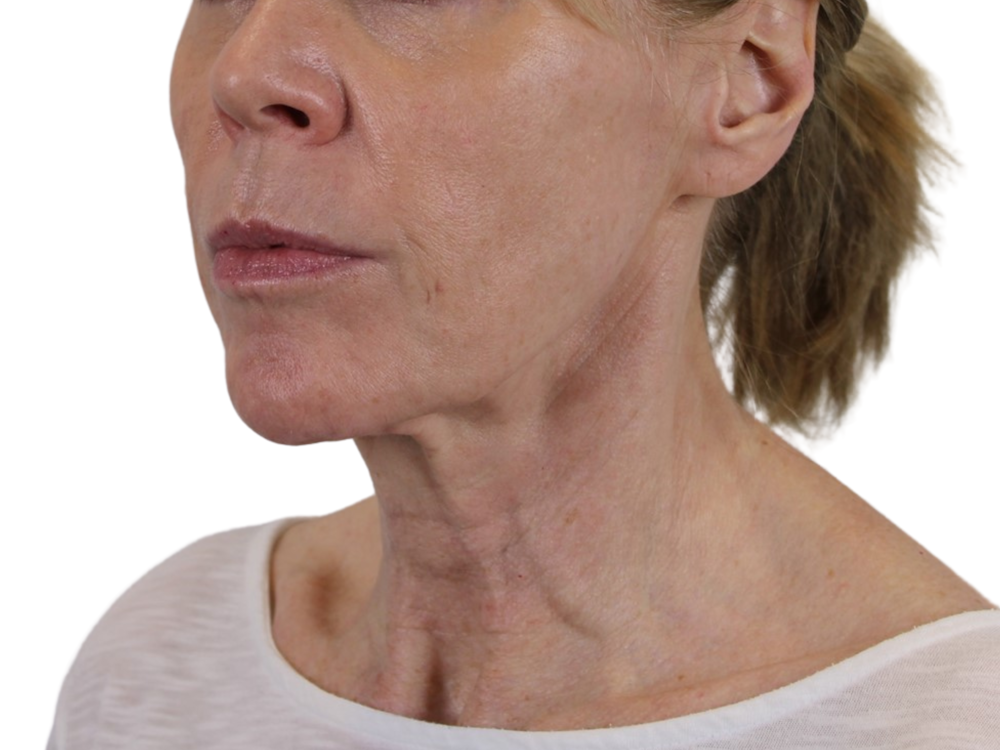 Deep Neck Lift Before & After Gallery - Patient 143555694 - Image 7