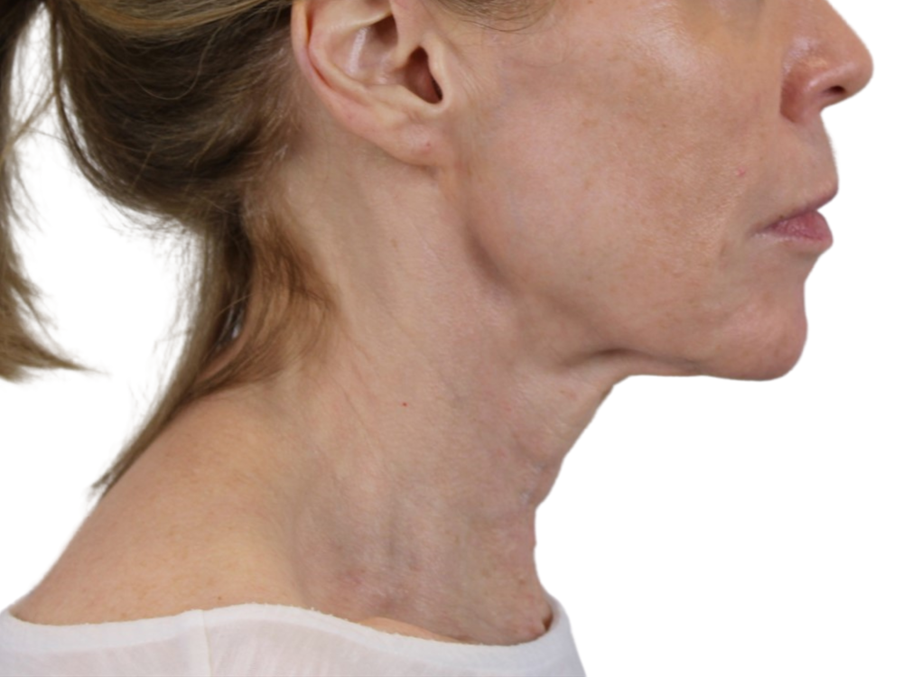 Deep Neck Lift Before & After Gallery - Patient 143555694 - Image 5