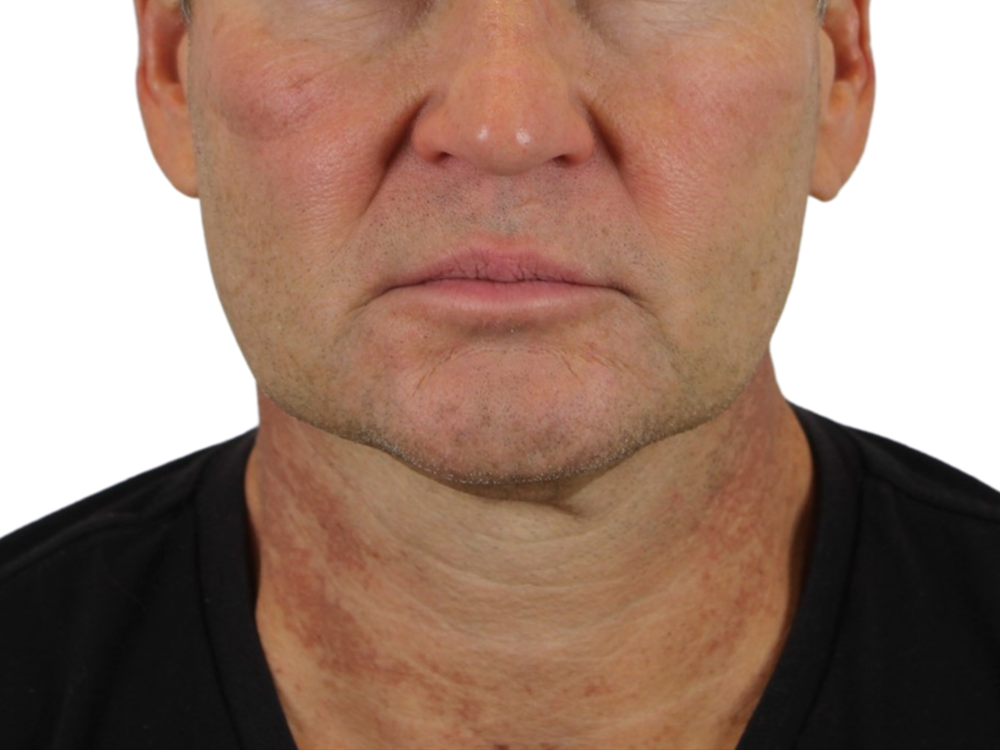 Deep Neck Lift Before & After Gallery - Patient 143555689 - Image 1
