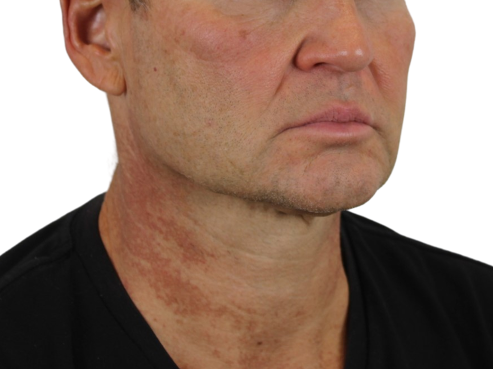 Neck Lift Before & After Gallery - Patient 143555689 - Image 3