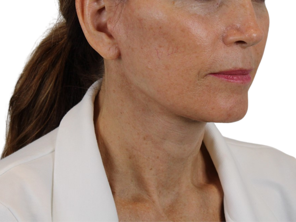Deep Neck Lift Before & After Gallery - Patient 143555698 - Image 2