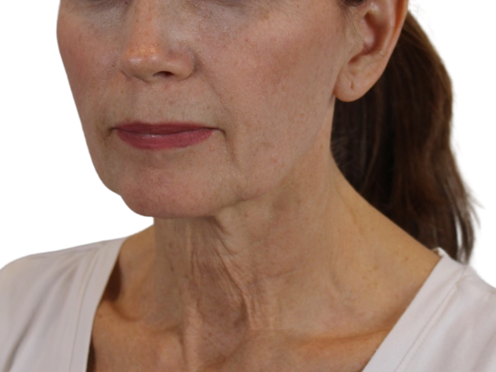 Deep Neck Lift Before & After Gallery - Patient 143555698 - Image 3