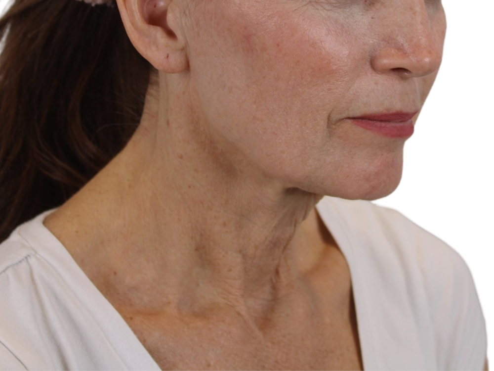 Deep Neck Lift Before & After Gallery - Patient 143555698 - Image 1