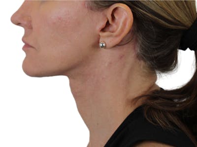 Deep Neck Lift Before & After Gallery - Patient 143555743 - Image 2