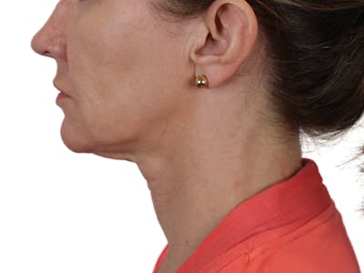 Neck Lift Before & After Gallery - Patient 143555743 - Image 2