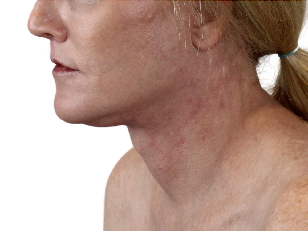 Neck Lift Before & After Gallery - Patient 143555742 - Image 4