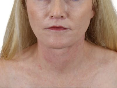 Neck Lift Before & After Gallery - Patient 143555742 - Image 2