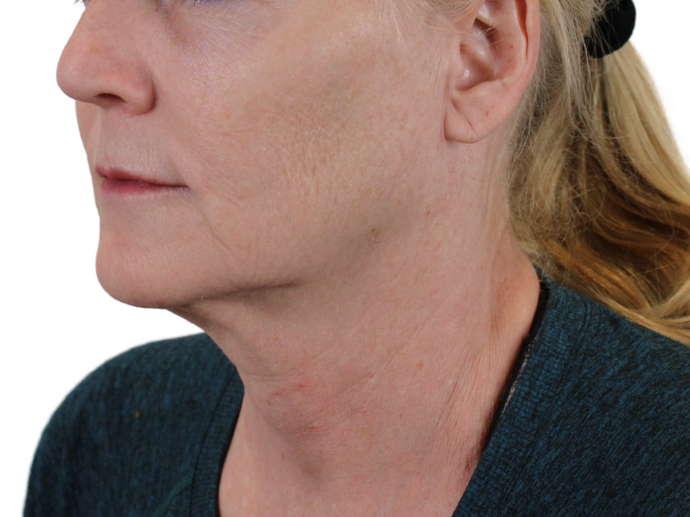Deep Neck Lift Before & After Gallery - Patient 143555742 - Image 3