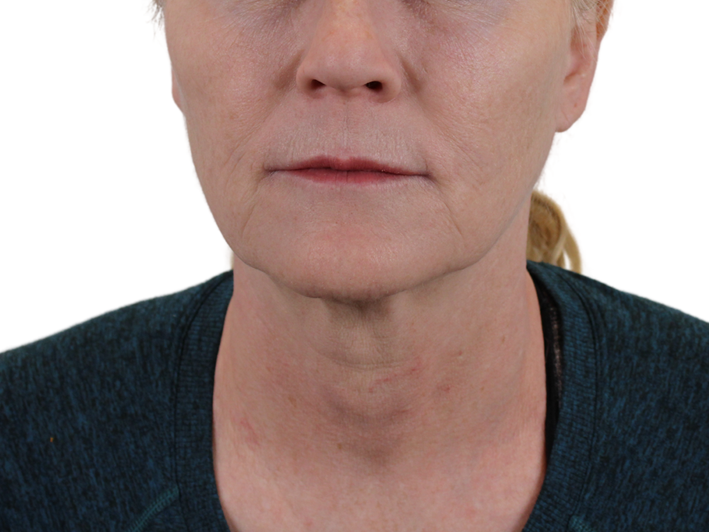 Deep Neck Lift Before & After Gallery - Patient 143555742 - Image 1