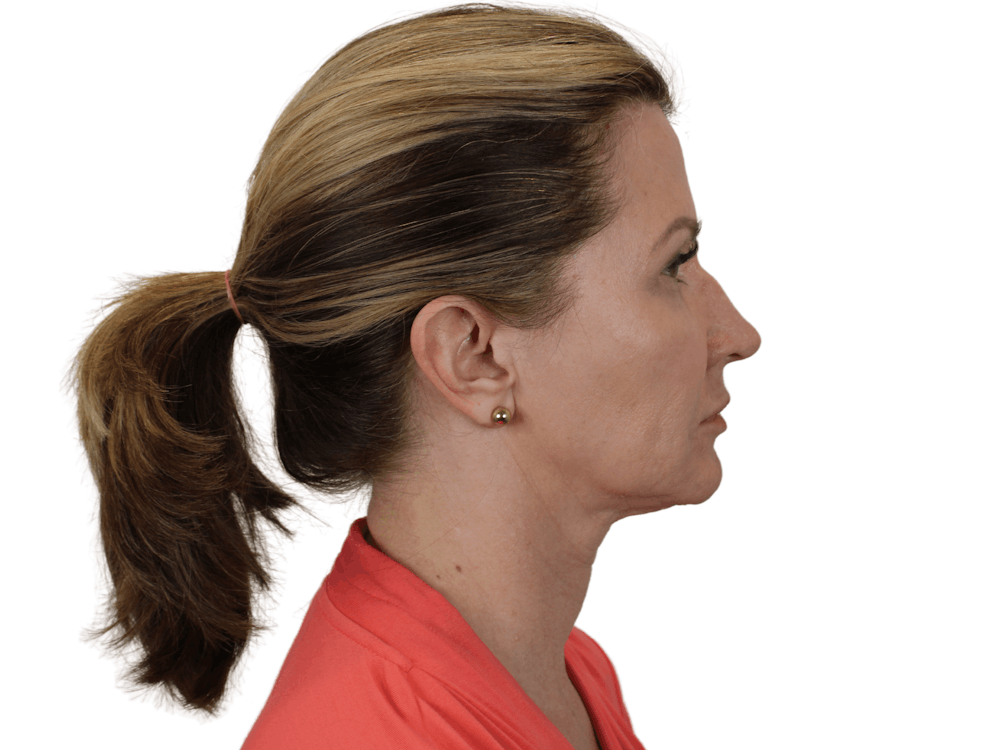 Deep Neck Lift Before & After Gallery - Patient 143804965 - Image 9