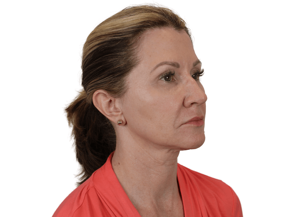 Deep Plane Facelift Before & After Gallery - Patient 143804962 - Image 5