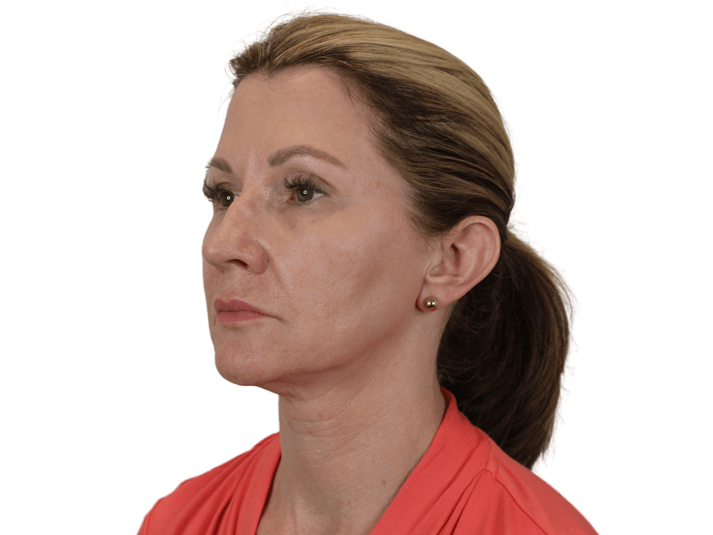 Deep Neck Lift Before & After Gallery - Patient 143804965 - Image 3