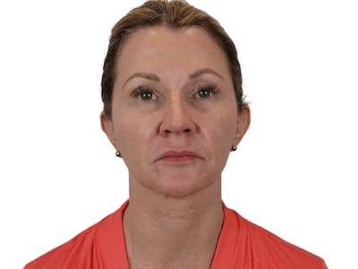 Facelift Before & After Gallery - Patient 143804962 - Image 1