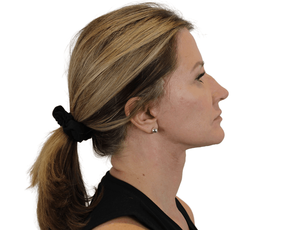 Deep Neck Lift Before & After Gallery - Patient 143804965 - Image 10