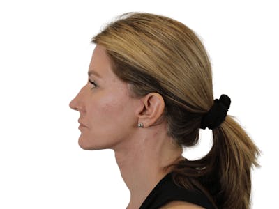 Deep Neck Lift Before & After Gallery - Patient 143804965 - Image 8