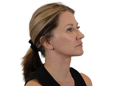 Deep Plane Facelift Before & After Gallery - Patient 143804962 - Image 6