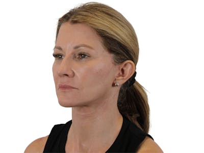 Deep Plane Facelift Before & After Gallery - Patient 143804962 - Image 4