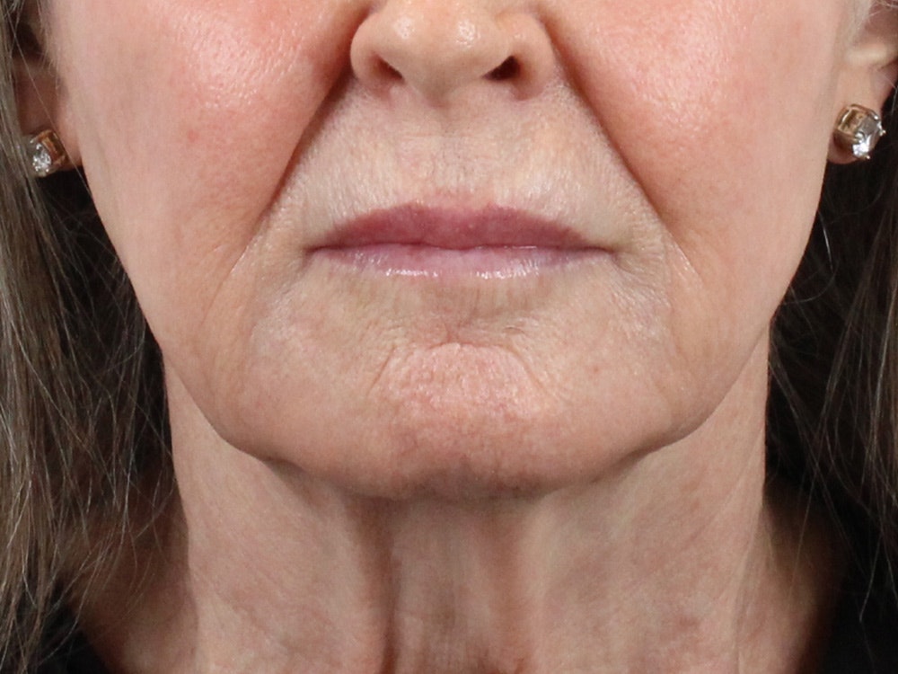 Chin Filler Before & After Gallery - Patient 144271666 - Image 1