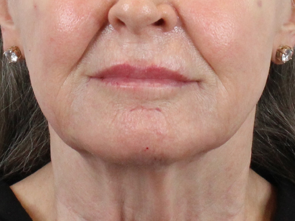 Chin Filler Before & After Gallery - Patient 144271666 - Image 2