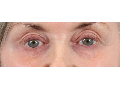 Tear Trough Filler Before & After Gallery - Patient 144271658 - Image 1