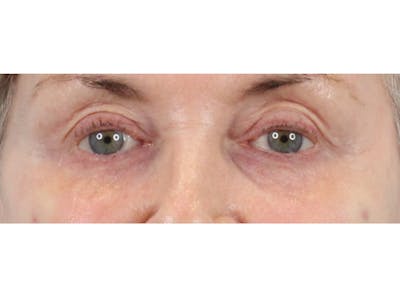 Tear Trough Filler Before & After Gallery - Patient 144271658 - Image 2