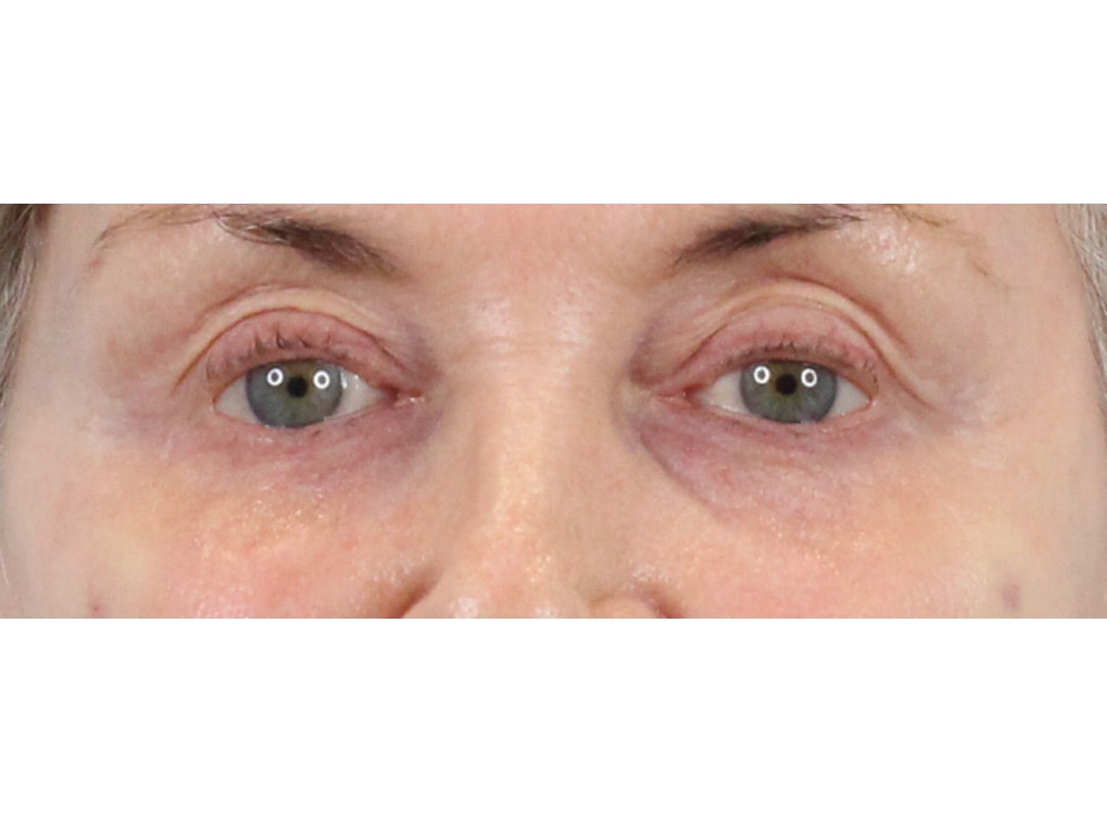 Tear Trough Filler Before & After Gallery - Patient 144271658 - Image 2