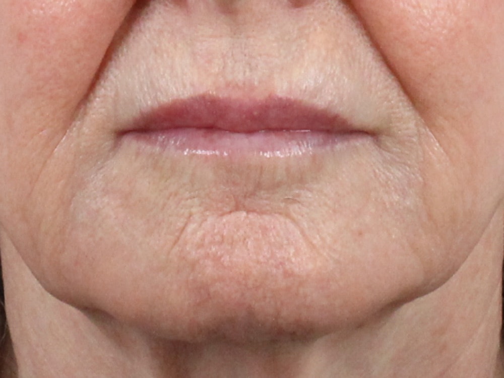 Lip Filler Before & After Gallery - Patient 144271664 - Image 1