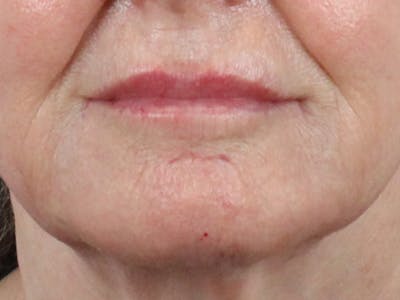 Lip Filler Before & After Gallery - Patient 144271664 - Image 2