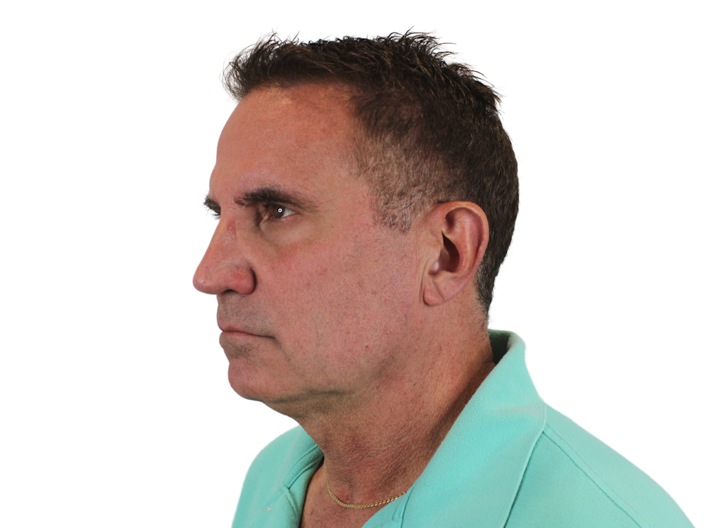 Deep Plane Facelift Before & After Gallery - Patient 144487267 - Image 5