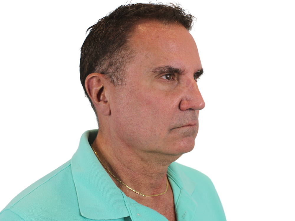 Deep Plane Facelift Before & After Gallery - Patient 144487267 - Image 1