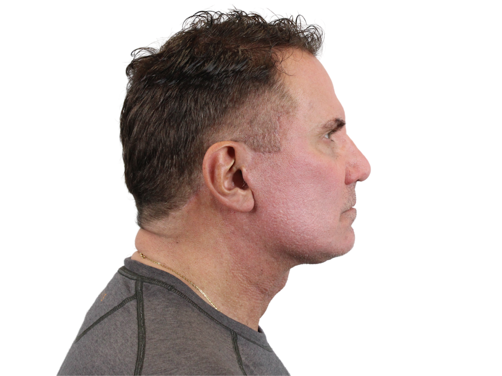 Deep Plane Facelift Before & After Gallery - Patient 144487267 - Image 4