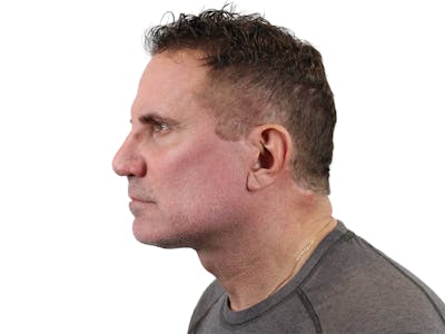 Deep Plane Facelift Before & After Gallery - Patient 144487267 - Image 8