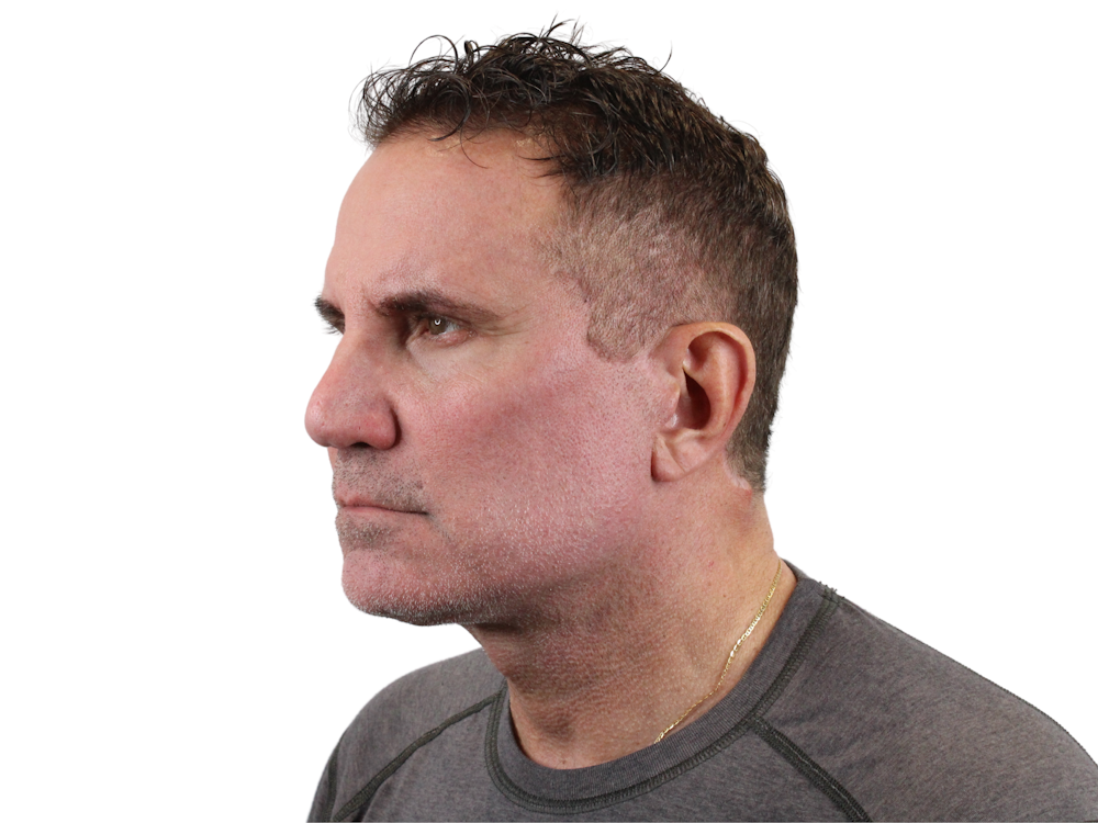 Deep Plane Facelift Before & After Gallery - Patient 144487267 - Image 6