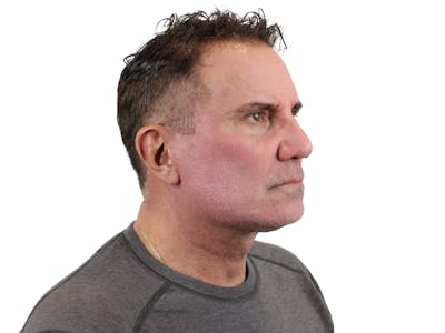 Deep Plane Facelift Before & After Gallery - Patient 144487267 - Image 2