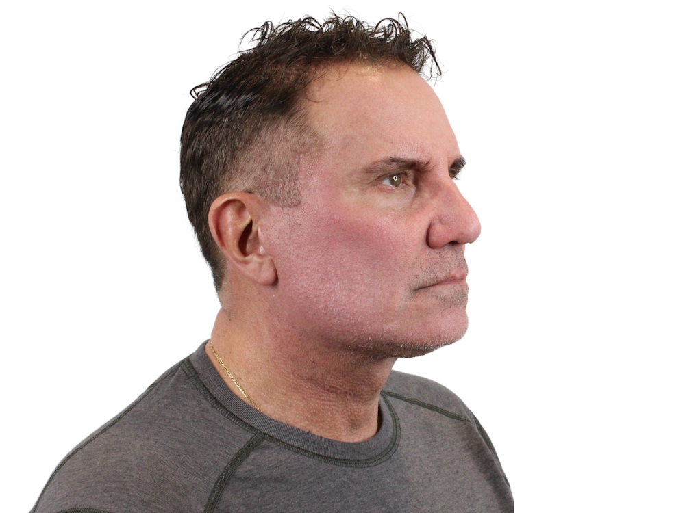 Deep Plane Facelift Before & After Gallery - Patient 144487267 - Image 2