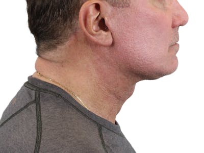 Deep Neck Lift Before & After Gallery - Patient 143555056 - Image 4